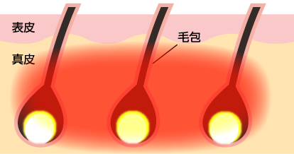SHR方式(蓄熱式脱毛)の原理